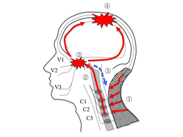 【図】片頭痛の起こり方