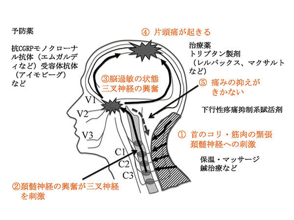 【図】片頭痛の治療アプローチ