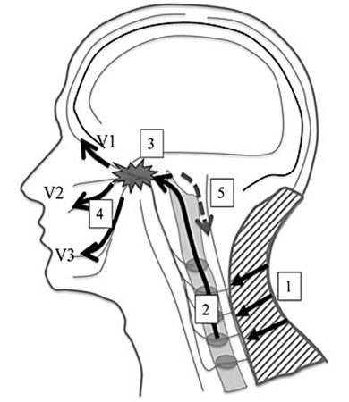 【図】PAPTによる首こりの改善とともに三叉神経痛の改善