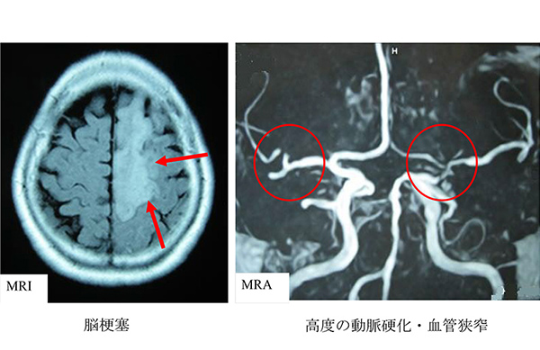 【図】脳梗塞・動脈硬化の写真